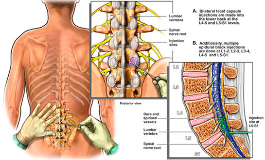 Epidural Anestezi ve Yan Etkileri Epidural Anestezi ve Yan Etkileri