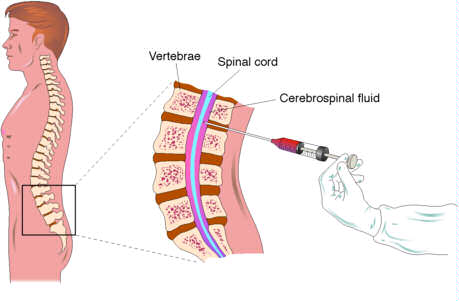 Spinal Anestezi